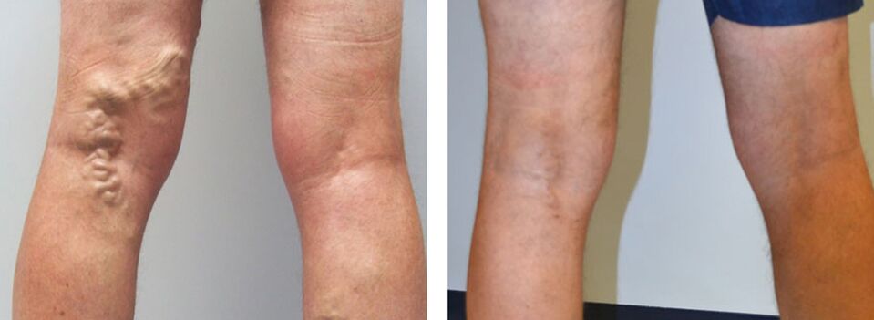 Fotó a Veniselle használata előtt és után, a krém használatának tapasztalata