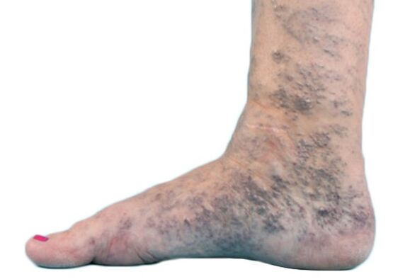 Varikoos vénák a lábakon