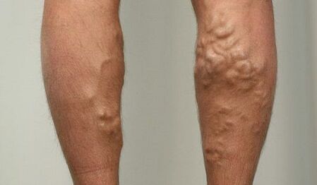 A varikoosák tünetei