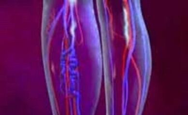 A varikozusok okai és kezelése