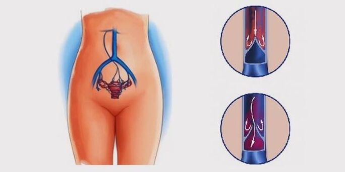 A medence varikózisai