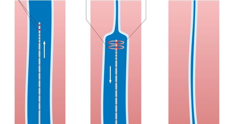 lézeres kezelés visszér kezelésére a lábakon