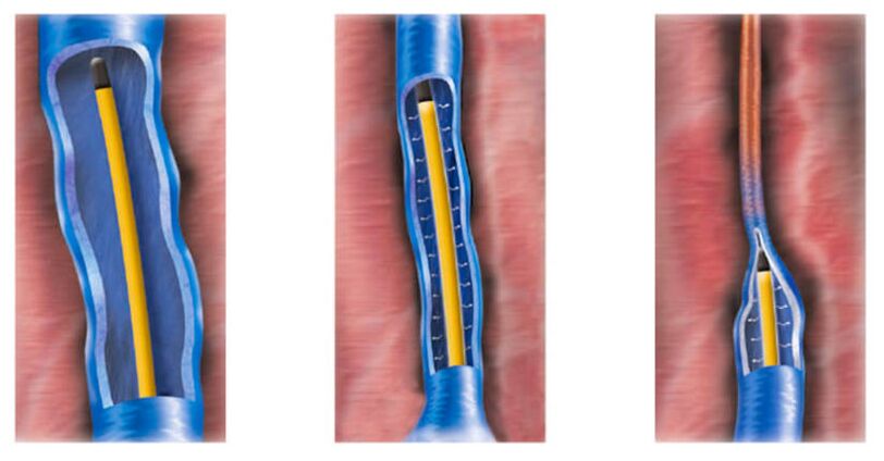 rádiófrekvenciás abláció, mint a varikózus vénák kezelési módszere