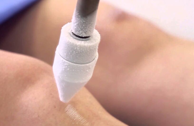 visszerek kezelése a lábakon krioterápiával